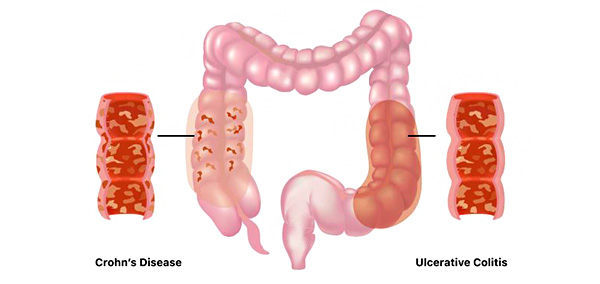 溃疡性结肠炎是一种结肠和直肠发炎的长期疾病。 结肠是大肠，直肠是储存粪便的肠道末端。 结肠内壁可能会出现小溃疡，并可能出血并产生脓液。